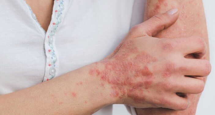 mucizevi-kur-3-4-kez-uygulayin-egzamadan-kurtulun_eaec0672